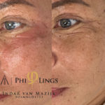 microneedling - philings