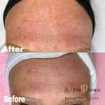 microneedling - philings