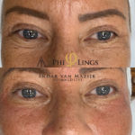microneedling - philings