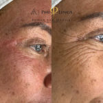 microneedling - philings