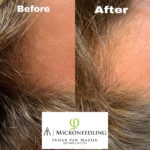 microneedling