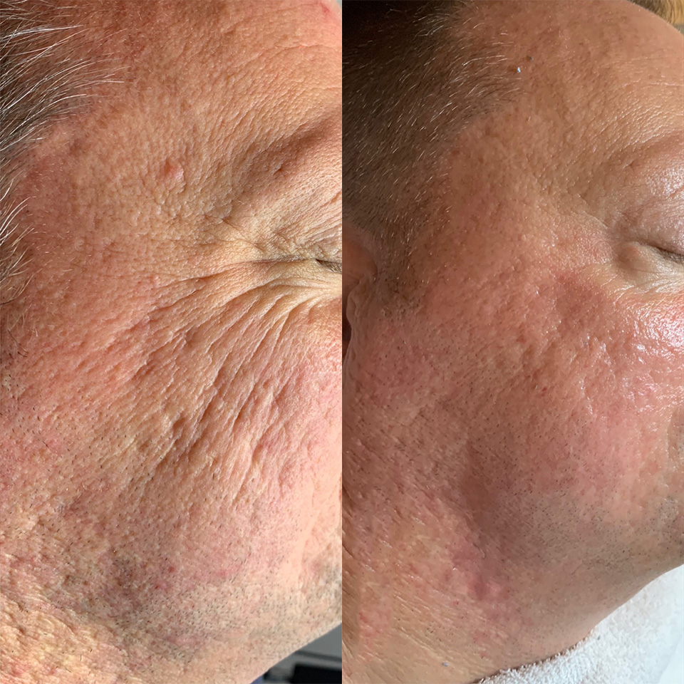 microneedling