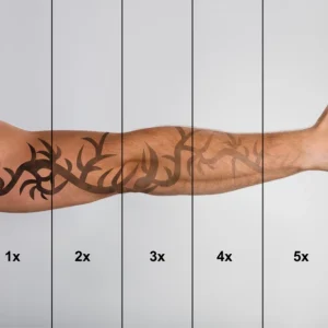 tattoo verwijderen
