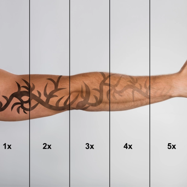 tattoo verwijderen