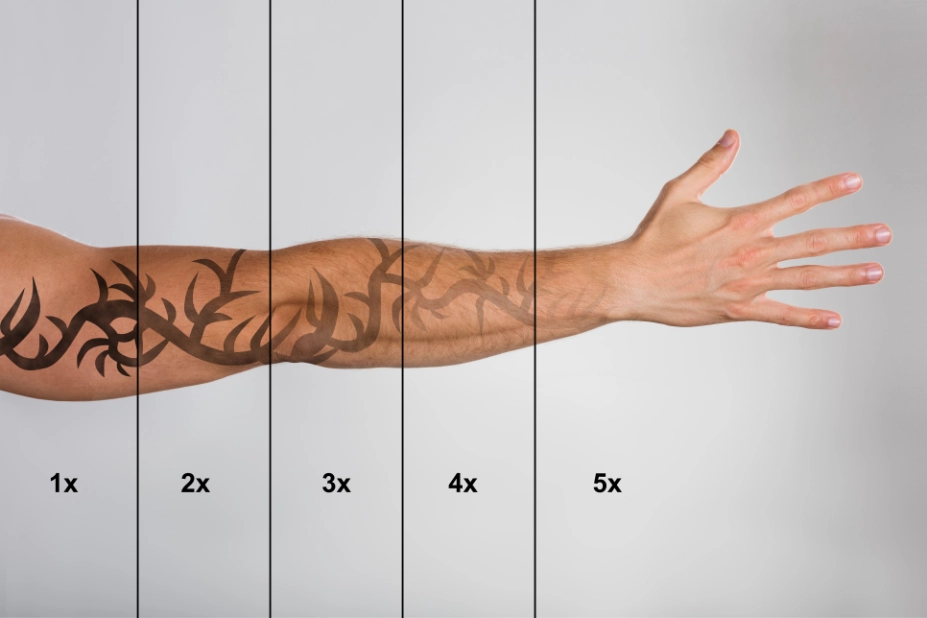 tattoo verwijderen